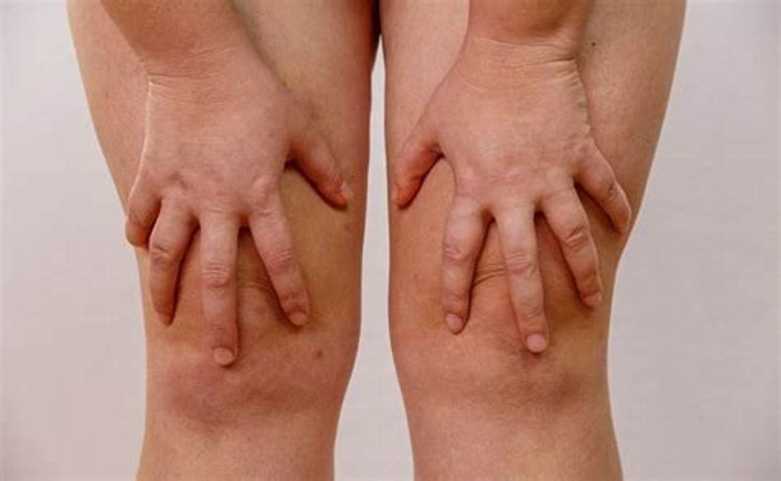 Como o lipedema pode restringir o movimento do seu joelho